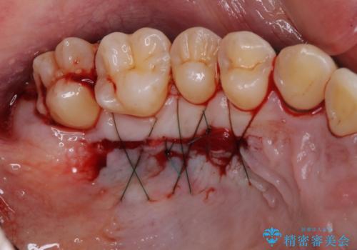 矯正歯科治療と前歯の歯肉移植術の治療後