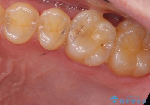 奥歯の虫歯　セラミックインレーにの症例 治療前