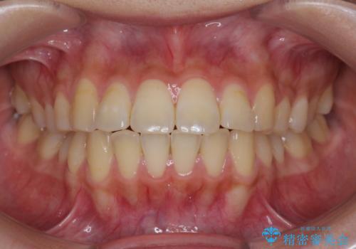 再矯正 一度抜かないでやったが、やっぱり抜いて口元下げたいの症例 治療前