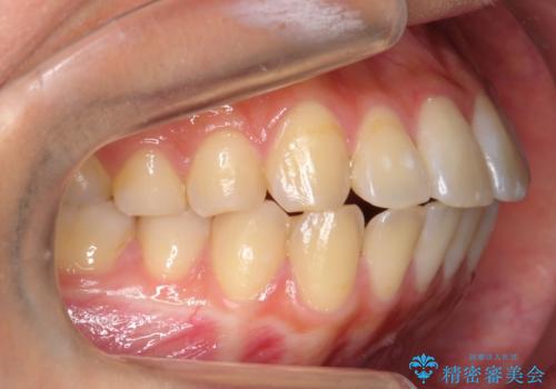 再矯正 一度抜かないでやったが、やっぱり抜いて口元下げたいの治療前