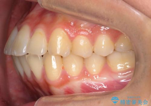 再矯正 一度抜かないでやったが、やっぱり抜いて口元下げたい