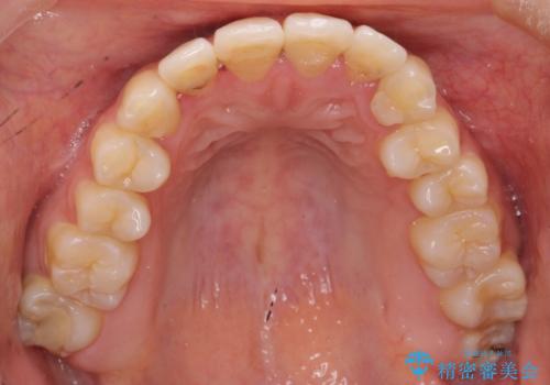 再矯正 一度抜かないでやったが、やっぱり抜いて口元下げたいの治療前
