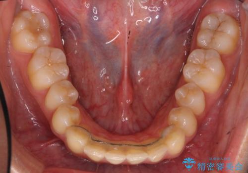 再矯正 一度抜かないでやったが、やっぱり抜いて口元下げたいの治療前