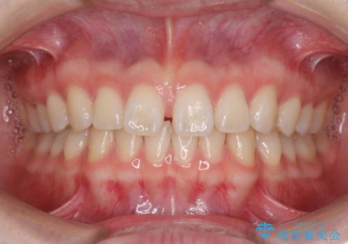 インビザラインによるすきっ歯の改善の症例 治療前