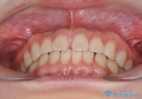 インビザラインによるすきっ歯の改善の治療前