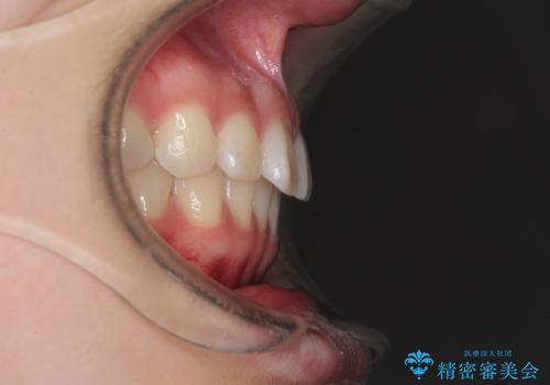 インビザラインによるすきっ歯の改善の治療前