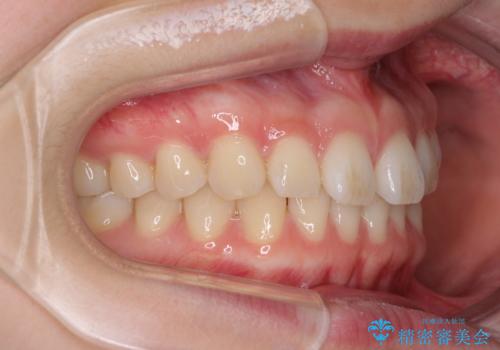 インビザラインによるすきっ歯の改善の治療前