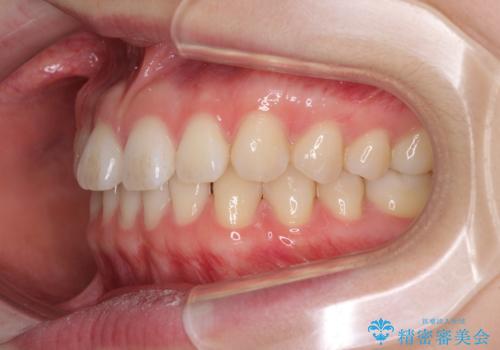 インビザラインによるすきっ歯の改善の治療前