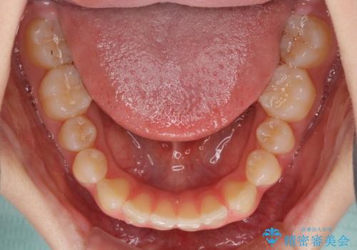 インビザラインによるすきっ歯の改善の治療前