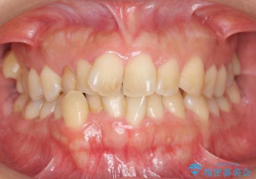 30代女性　残った乳歯を抜いてスペースを閉じる矯正　前歯のねじれの治療前