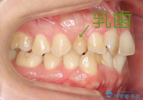 30代女性 残った乳歯を抜いてスペースを閉じる矯正 前歯のねじれの治療前