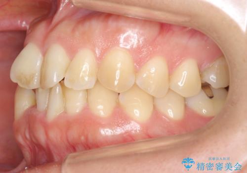 30代女性 残った乳歯を抜いてスペースを閉じる矯正 前歯のねじれの治療前
