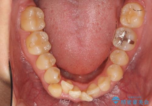 30代女性 残った乳歯を抜いてスペースを閉じる矯正 前歯のねじれの治療前
