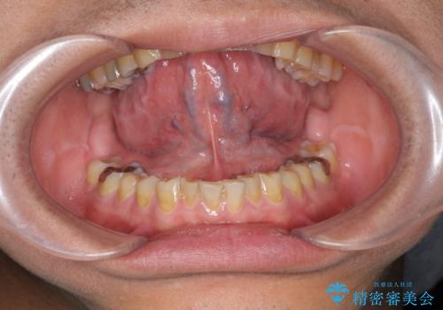 [日帰り手術] 舌小帯切除　滑舌をよくしたいの治療前