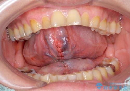 [日帰り手術] 舌小帯切除　滑舌をよくしたいの治療中