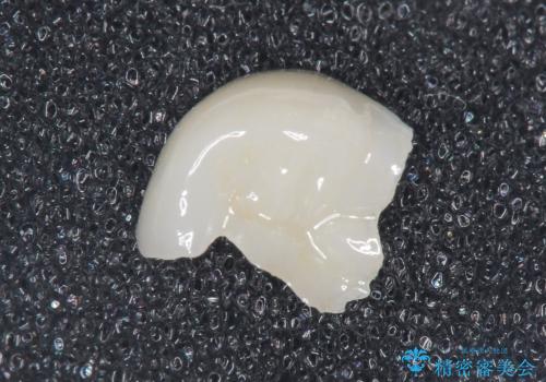 深い虫歯 丁寧にう蝕を除去し神経を保存 30代男性の治療中