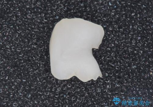 深い虫歯 丁寧にう蝕を除去し神経を保存 30代男性の治療中