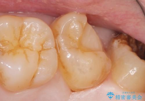 深い虫歯 丁寧にう蝕を除去し神経を保存 30代男性の治療中