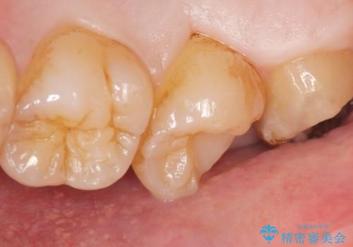 深い虫歯 丁寧にう蝕を除去し神経を保存 30代男性の治療中