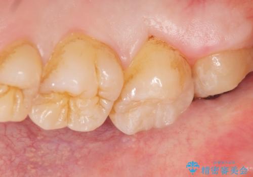 深い虫歯 丁寧にう蝕を除去し神経を保存 30代男性の治療後