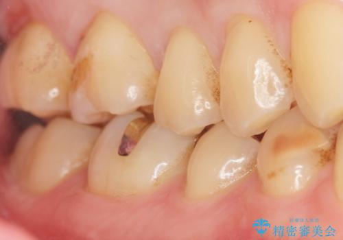 深い虫歯 丁寧にう蝕を除去し神経を保存 30代男性の治療後