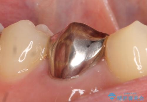 オールセラミッククラウン 咬むと痛む歯の根管治療~補綴の治療前