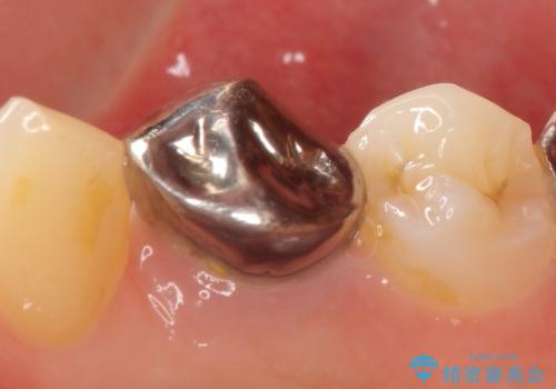 オールセラミッククラウン 咬むと痛む歯の根管治療~補綴の治療前