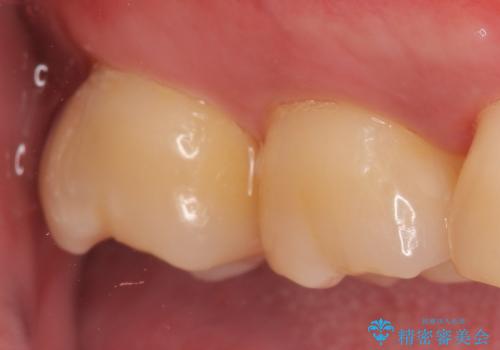 オールセラミッククラウン 他院にて抜歯と言われた歯の治療の治療前