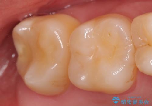 オールセラミッククラウン 他院にて抜歯と言われた歯の治療の治療前