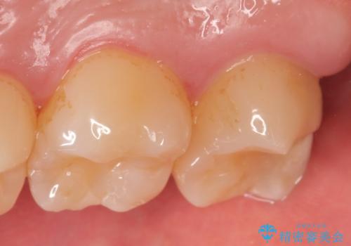 オールセラミッククラウン 他院にて抜歯と言われた歯の治療の治療前