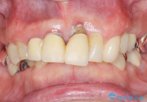 親知らずの移植 70代男性の治療後