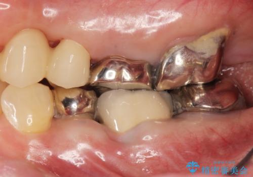 親知らずの移植 70代男性の症例 治療後