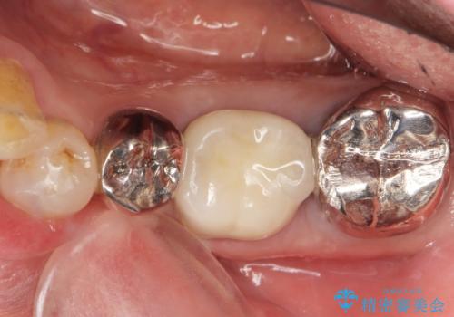 親知らずの移植 70代男性の治療後