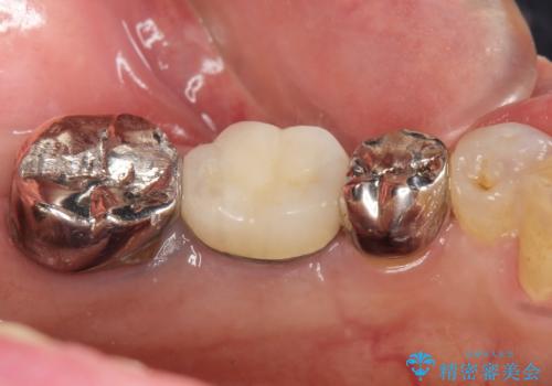 親知らずの移植 70代男性の治療後