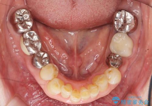 親知らずの移植 70代男性の治療後