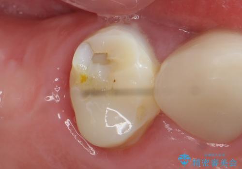 オールセラミッククラウン 治療途中の歯の補綴の症例 治療前