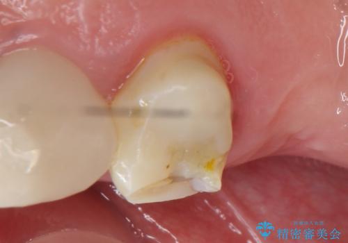 オールセラミッククラウン 治療途中の歯の補綴の治療前