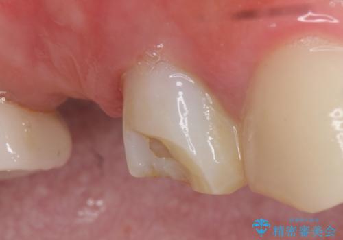 オールセラミッククラウン 治療途中の歯の補綴の治療前