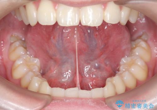 成人の舌小帯切除 舌が動かしにくいの治療前