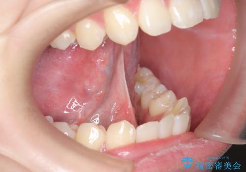 成人の舌小帯切除　舌が動かしにくいの治療前