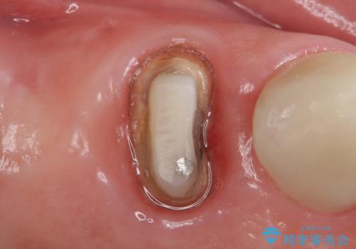 オールセラミッククラウン 治療途中の歯の補綴の治療中