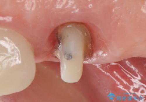 オールセラミッククラウン 治療途中の歯の補綴の治療中