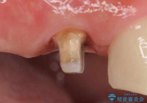 オールセラミッククラウン 治療途中の歯の補綴の治療中