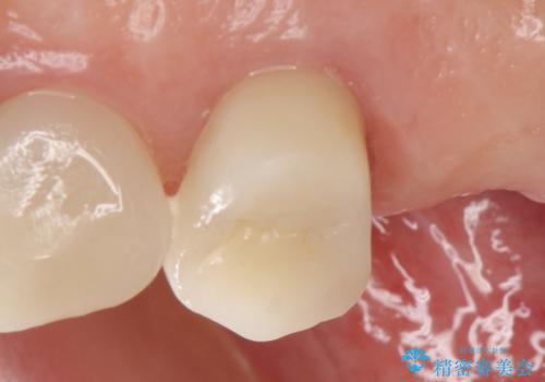 オールセラミッククラウン 治療途中の歯の補綴の治療後