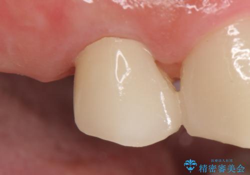 オールセラミッククラウン 治療途中の歯の補綴の治療後