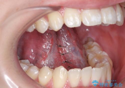 成人の舌小帯切除　舌が動かしにくいの治療中