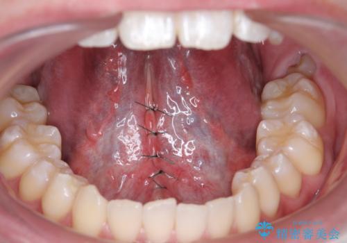成人の舌小帯切除　舌が動かしにくいの治療中