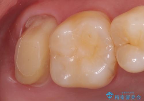 オールセラミッククラウン 他院にて抜歯と言われた歯の治療の治療中