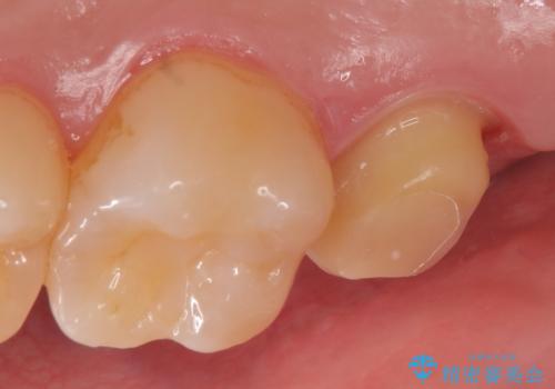 オールセラミッククラウン 他院にて抜歯と言われた歯の治療の治療中