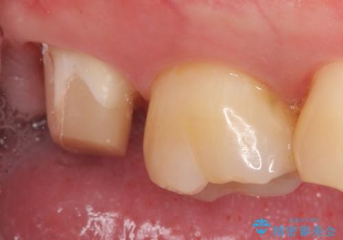 オールセラミッククラウン 他院にて抜歯と言われた歯の治療の治療中